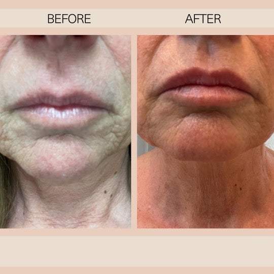 REPLENISH Hyaluron Peptide Ampoule – Peptide + Hyaluronic Acid