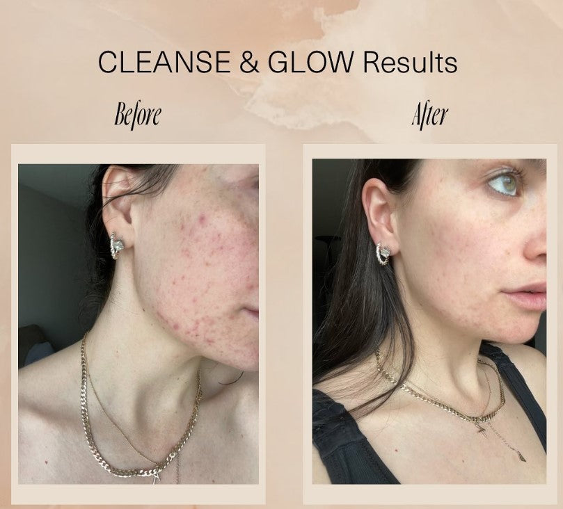 Before and after photos of a customer's skin using the CLEANSE & GLOW Set