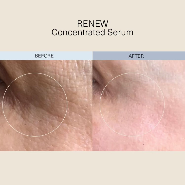 Before and after close-up of skin texture for RENEW Concentrated Serum